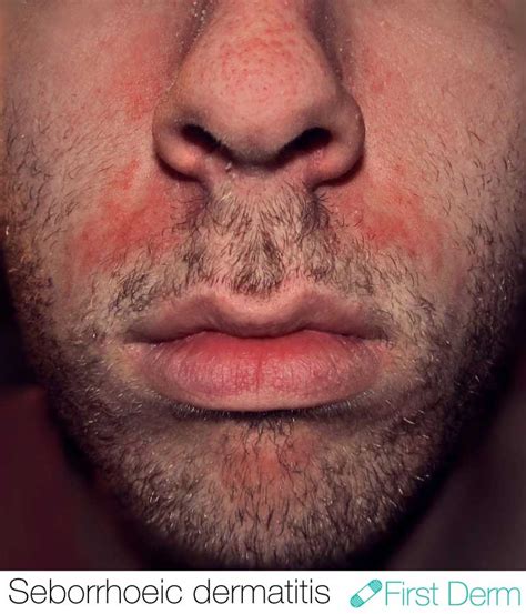 First Derm Seborrhoeic Dermatitis Picture Upper Lip Icd 10 L21