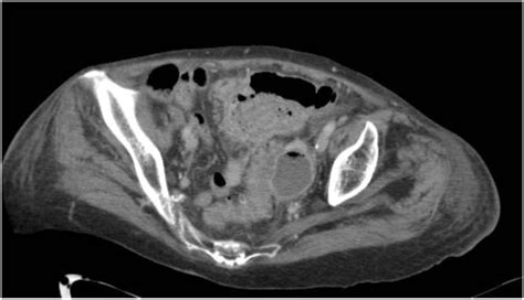 Sigmoid Diverticulitis With Associated Abscess Formation Download