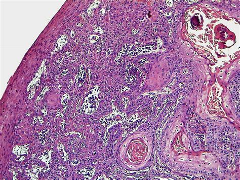 Cureus A Case Report Of Scrotal Squamous Cell Carcinoma Secondary To