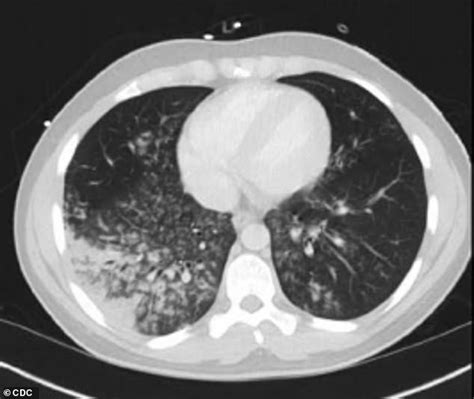 Rare Form Of Pneumonia Among Outbreak Of Mysterious Lung Illnesses