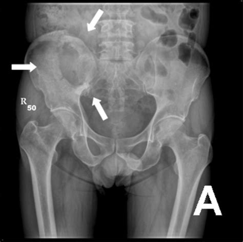 Maybe you would like to learn more about one of these? File:Radiography pelvis with bone metastasis 01.jpg ...