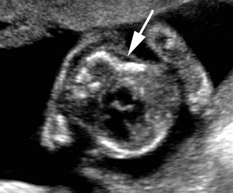Campomelic Dysplasia Ultrasound