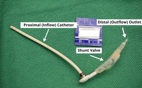 Example Of A Vp Shunt From An Autopsy Unrelated To Our Cases The