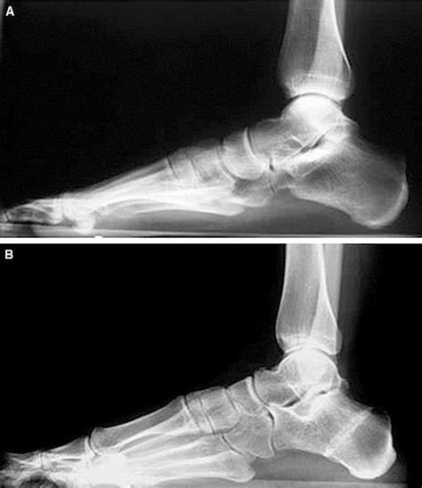 Surgical Treatment Of Stage Ii Posterior Tibialis Tendon Dysfunction