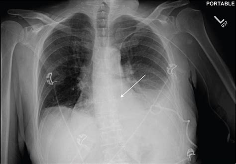 Malpositioned Lines And Tubes On Chest Radiograph A Concise Pictorial