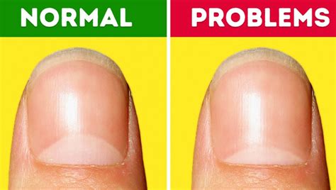 4 Signs Through Which Nails Shows Symptoms Of Various Diseases Nail Health Problems
