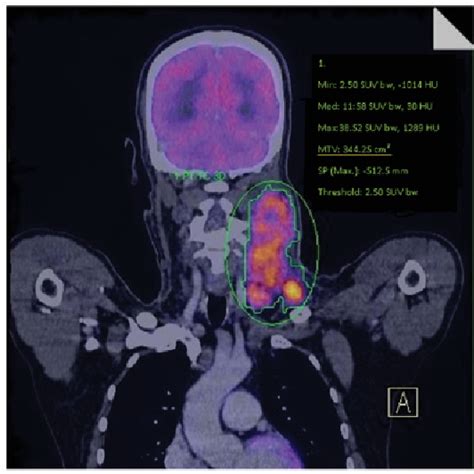 figure 1 from fluorodeoxyglucose positron emission tomography ‐ computed tomography for the
