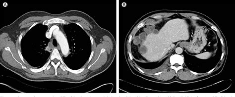Figure 1 From A Case Of Pulmonary Paragonimiasis Mimicking Lung Cancer