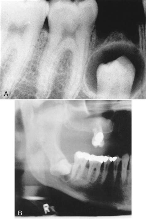 17 Oral Pathology Pocket Dentistry