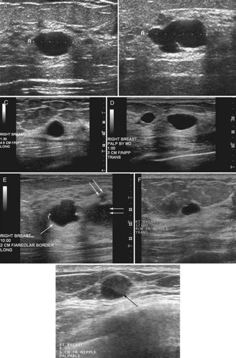 Breast Ultrasound Radiology Key