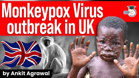 Monkeypox Virus Wales Jun 10 2021 · The First Monkeypox Patient