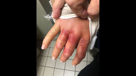 Knoxville Woman Almost Loses Arm From Flesh Eating Bacteria Blames