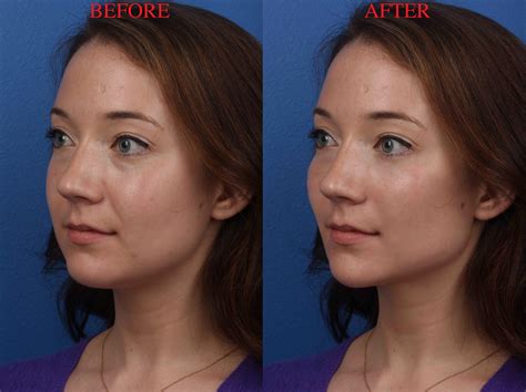I Had My Face Morphed By A Plastic Surgeon And Was Shocked By The Results Business Insider