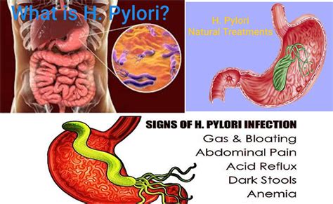 Helicobacter Pylori H Pylori Infection Causes Symptom Natural