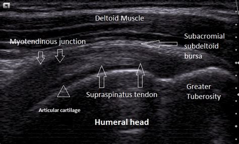 The supraspinatus muscle originates from the superior fossa of the shoulder blade and has its insertion at the greater trochanter of the humerus. Ultrasound Leadership Academy: Intro to Shoulder Evaluation — EM Curious