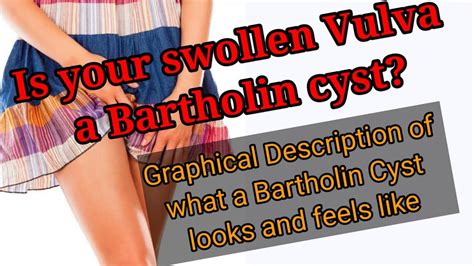 HOW TO IDENTIFY A BARTHOLIN CYST What Is A Bartholin Cyst YouTube