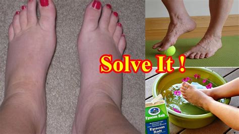 6 Natural Home Remedies For Swollen Feet And Ankles Youtube