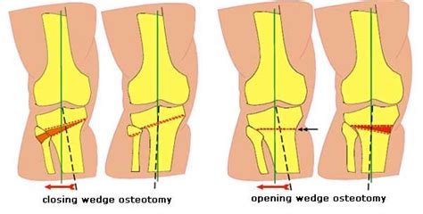 High Tibial Osteotomy To Correct A Valgus Knock Knee Or Varus Bow