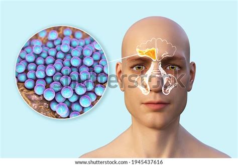 Sinusitis Inflammation Paranasal Cavities 3d Illustration Stock