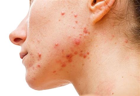 Acne Blemished And Congested Skin Skin Concerns Geelong