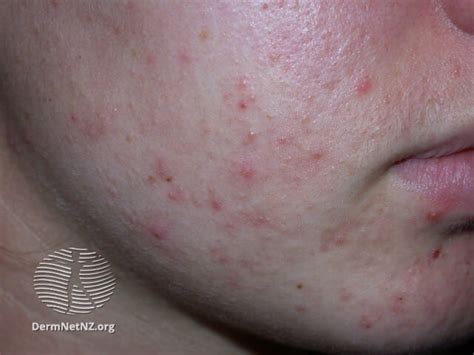 Acne Vulgaris Causes Symptoms And Effective Treatments