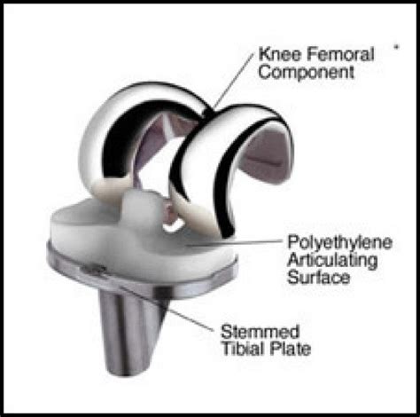 Total Knee Replacement Types