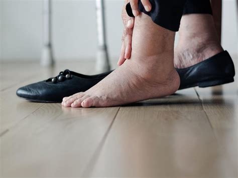 Obrzęki nóg opuchlizna nóg dlaczego nogi puchną Ars Estetica