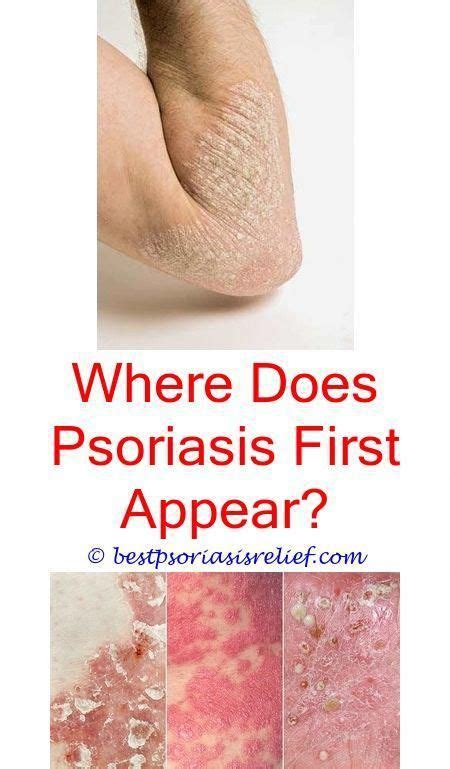 Pin On Topical Treatment For Scalp Psoriasis