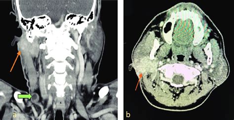 A Coronal Ct Scan Shows An Irregular Shape Contrast Enhanced Right