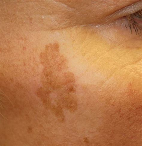 Black Spots On Skin Causes