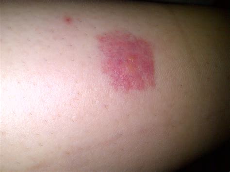 Muggen als dragers van tropische ziekten spelen nog geen rol in duitsland. Wat kan dit zijn: Een grote rode kring op mijn arm waar ...