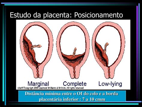 Placenta De Inserção Posterior