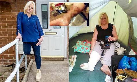 Breaston Woman Needed Her Leg Amputated After A Cut While Shaving