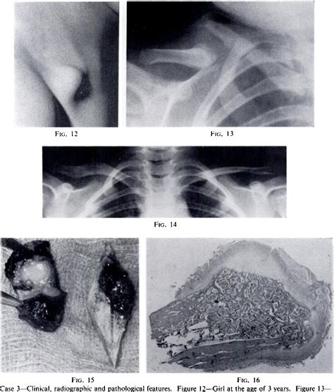 Figure 15 From Congenital Pseudarthrosis Of The Clavicle Semantic