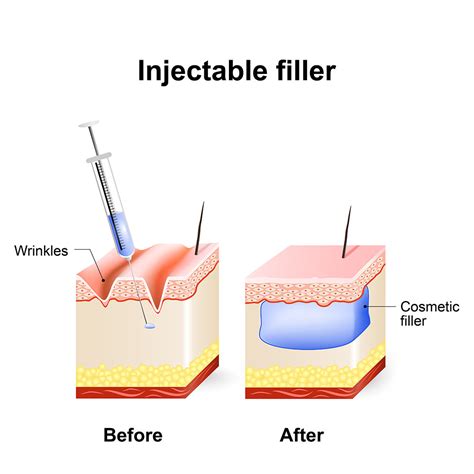 Cosmetic Injectables Dr Harinder S Chahal Md