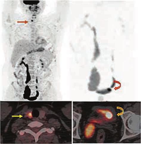 Fdg Pet Revealed Hypermetabolic Right Thyroid Nodule Straight Arrow