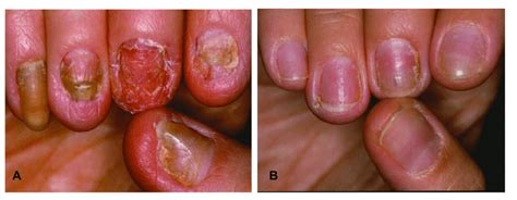 Psoriatic Nail Dystrophy Definition Nail Ftempo