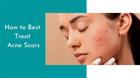 How To Best Treat Acne Scars