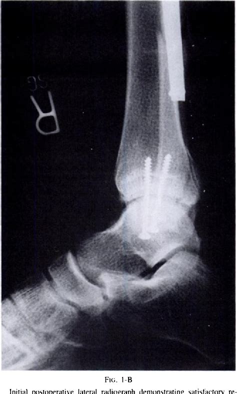 Figure I From Posterior Malleolar Fractures Of The Ankle Associated With External Rotation