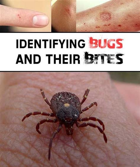 Pin On Bug Bite Remedies