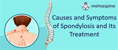 Spondylolysis Of The Lumbar Spine Symptoms Causes Treatments Images