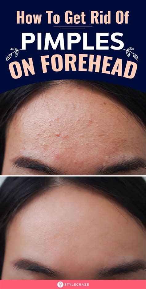How To Get Rid Of Pimples On Forehead Pimples On Forehead Clear Skin