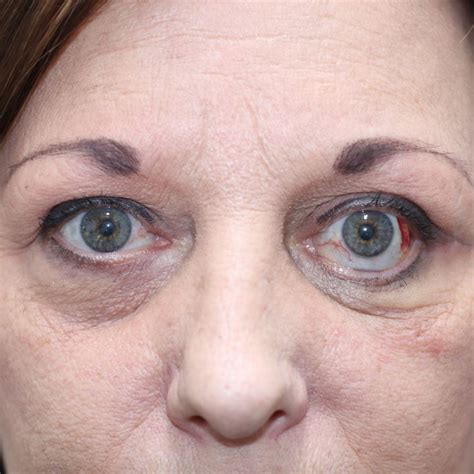 Before And After Thyroid Eye Disease