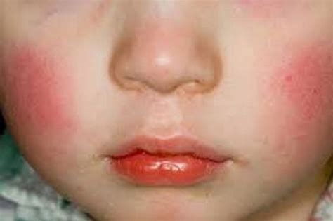 These Are The Symptoms Of Slapped Cheek Syndrome For Parents To Look