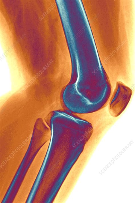 Healthy Knee Joint X Ray Stock Image C0096755 Science Photo Library