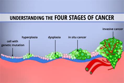 Cancer Staging The Petree Blog