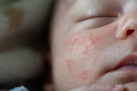 Closeup Detail Of The Cheek Of A Newborn Baby With Neonatal Acne Skin
