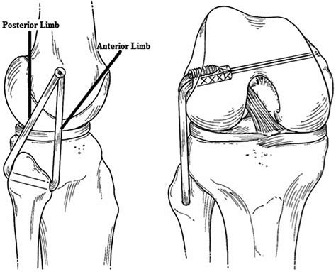 Posterolateral Corner Reconstruction In Combined Injuries Of The Knee