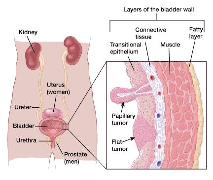 Bladder cancer may make it uncomfortable to eat or make you feel like you. What Is Bladder Cancer?