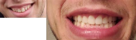 Completed 6 Months Total 20 Trays Rinvisalign